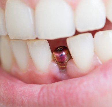 A closeup of a single tooth implant’s abutment
