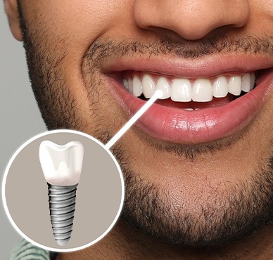 A happy, smiling man with a completed dental implant