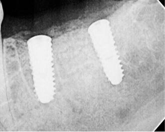 After same day dental implant