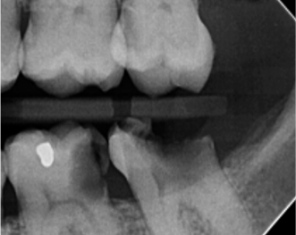 Before same day dental implant