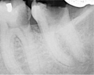 Same day dental implant treatment