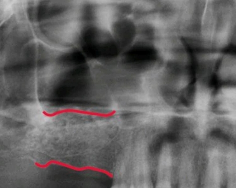 After sinus lift