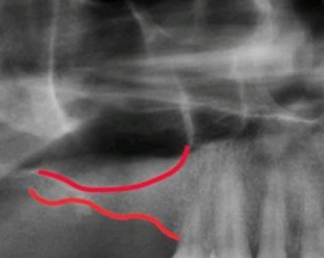 Before sinus lift