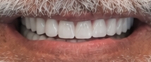 Close up of a smile with newly restored and whitened teeth