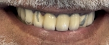 Close up of a smile with slightly gapped and yellowed teeth
