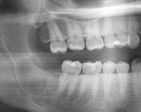 After wisdom tooth extraction