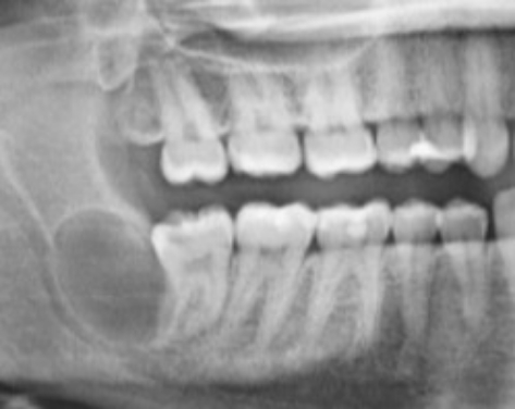 Before wisdom tooth extraction