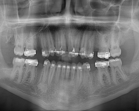 After wisdom tooth extraction