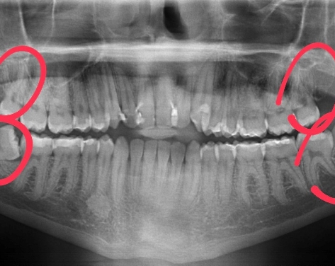 Before wisdom tooth extraction