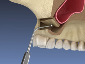 Digital rendering of a sinus lift