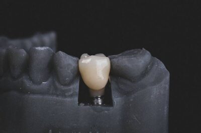 A dental implant with a realistic tooth attached, showcasing the integration of artificial and natural elements.