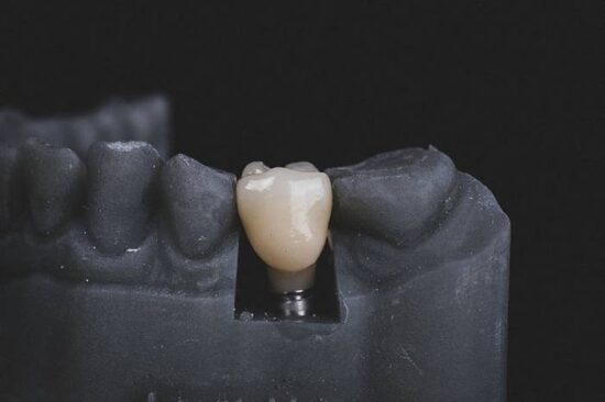 A dental implant with a realistic tooth attached, showcasing the integration of artificial and natural elements.