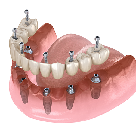 Illustration of dental implants.