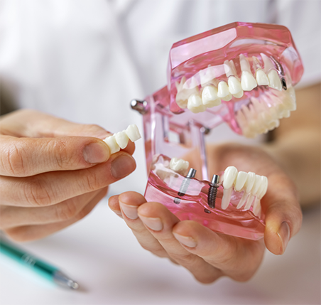 Dentist holding a replica of dental implants.