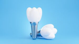 Dental implants on a blue background